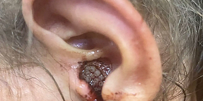 3 yaşındaki çocuğun kulağından 23 tane canlı kurtçuk çıkarıldı