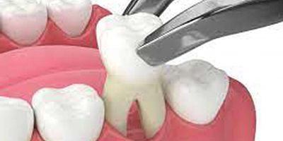 Diş kaybı ile gelen sorunlara dikkat!