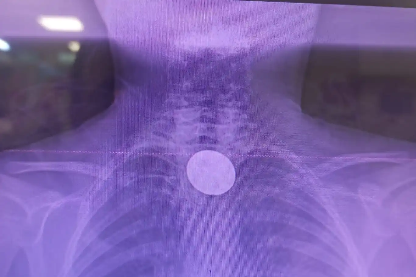 Siirt’te küçük çocuğun yuttuğu madeni para başarılı operasyonla çıkarıldı