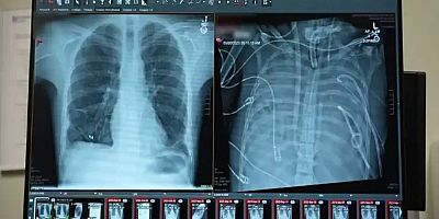 Yapay akciğer nakle kadar hastayı hayatta tuttu